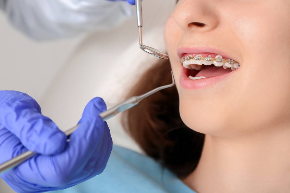 Tips To Maintain Oral Hygiene With Orthodontic Treatment